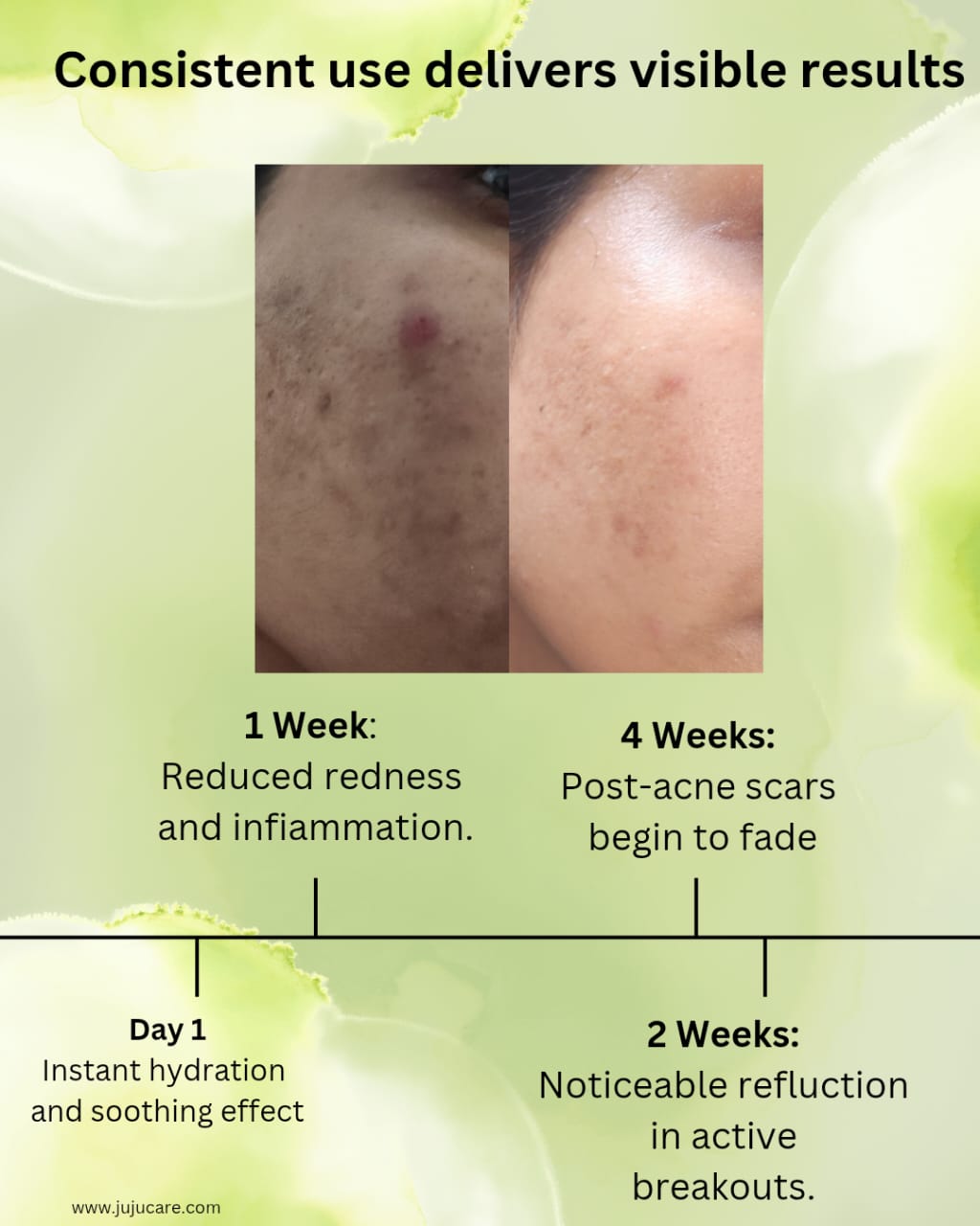 JUJU's Anti Acne cream 50g - Image 3